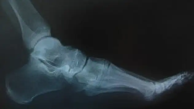 Kırıkların tedavisinde ipek vidalar kullanıldı