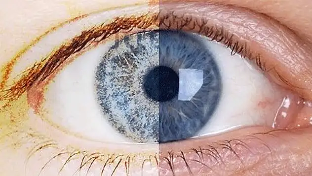 Her 2 kişiden biri kuru göz hastalığıyla karşı karşıya