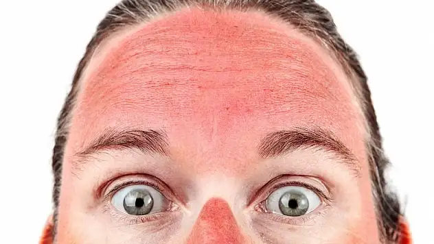 Sağlıklı Bronzlaşmak İçin Dikkat Etmeniz Gerekenler