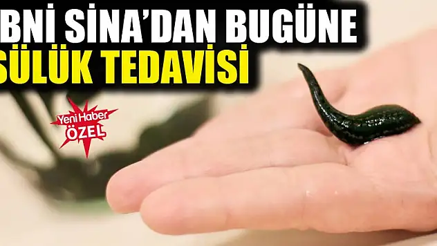 İbni Sina'dan bugüne sülük tedavisi