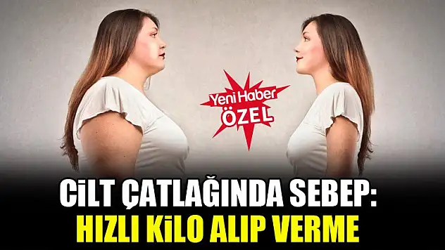Cilt çatlağında sebep:  Hızlı kilo alıp verme