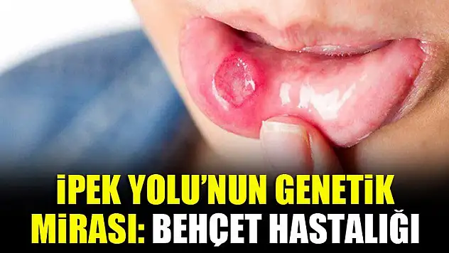 İpek Yolu'nun genetik mirası: Behçet hastalığı