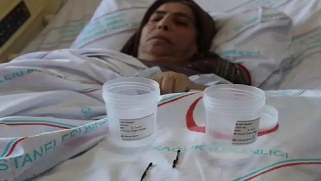 2 yaşındayken yuttu, 66 yıl sonra çıkarıldı