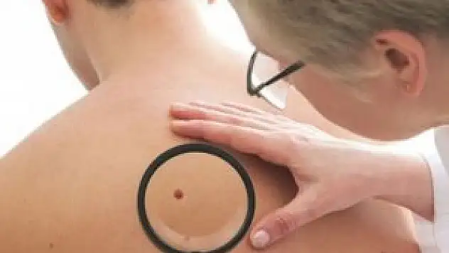 Çapı 20 santimden büyük benler risk taşıyor