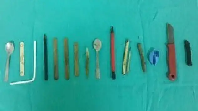 Midesinden meyve bıçağı ve çay kaşığı çıktı, doktorları bile şaşırdı