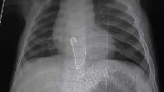 ÇENGELLİ İĞNE YUTAN 8 AYLIK BEBEK HASTANELİK OLDU