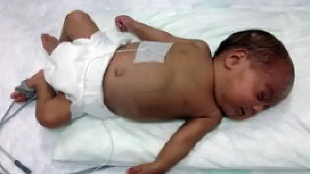 İkizini kaybetti yaşama sarıldı