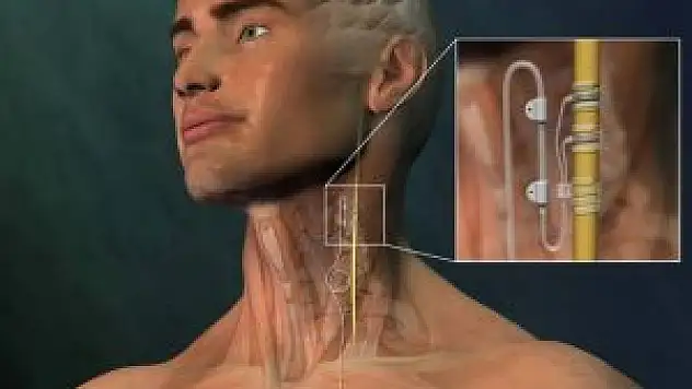 Epilepsi nöbetlerine ''Pilli'' çözüm