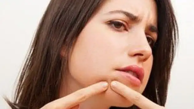 Sıkılan sivilce cilde bakın nasıl zarar veriyor