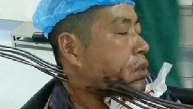 Boğazına 6 demir saplanan işçinin mucize kurtuluşu