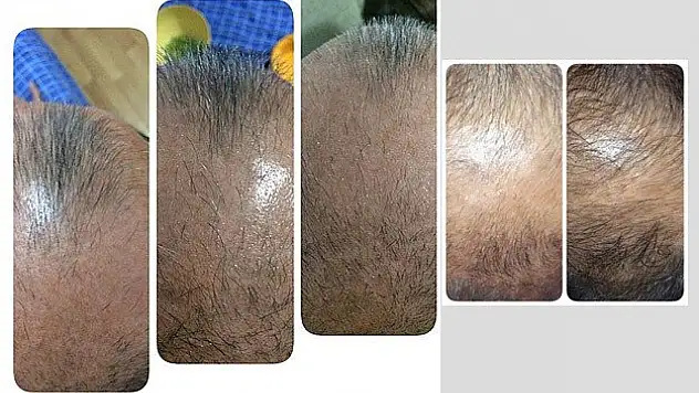 Saç dökülmesine nanoteknoloji ile çözüm