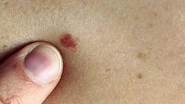 Kırmızı ben deyip geçmeyin!