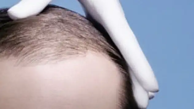 Kanser tedavisinde saç dökülmesi