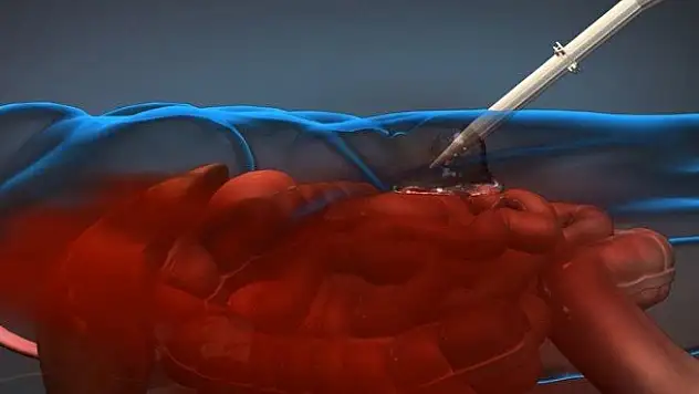 İç kanamayı kontrol eden köpük