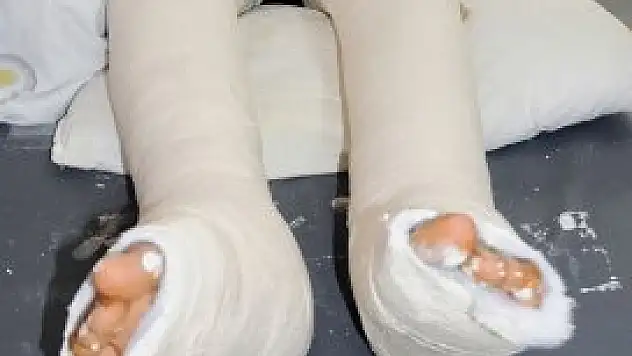 Sigara içenin kırığı geç iyileşiyor