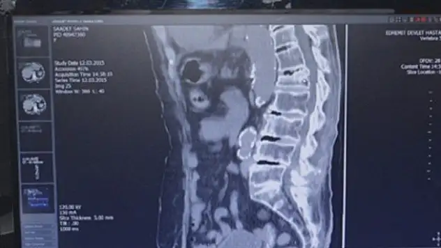 90 yaşındaki hastaya kemik çimentosu