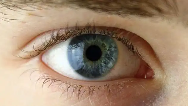 Göz tansiyonunda erken tanı körlüğü engelliyor