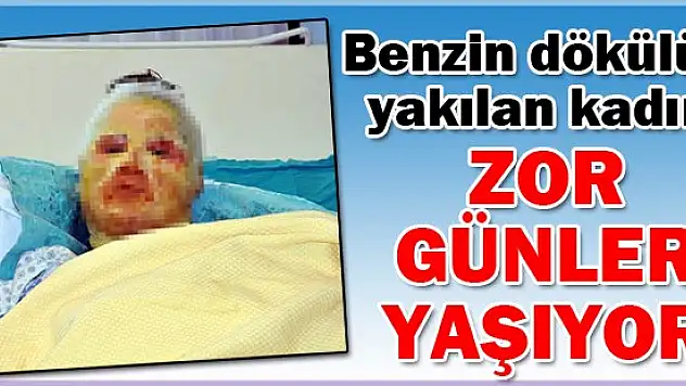 Benzin dökülüp yakılan kadın zor günler yaşıyor