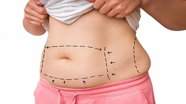 Liposuction ile Kalıcı Zayıflama Mümkün mü?