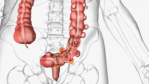 Onkoloji uzmanından kolon kanseri uyarısı: 45 yaş altı vakalarda büyük artış