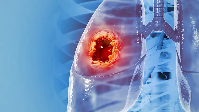 Akciğer kanseri erkeklerde daha fazla