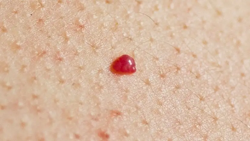 Ciltte beliren kırmızı benlere dikkat