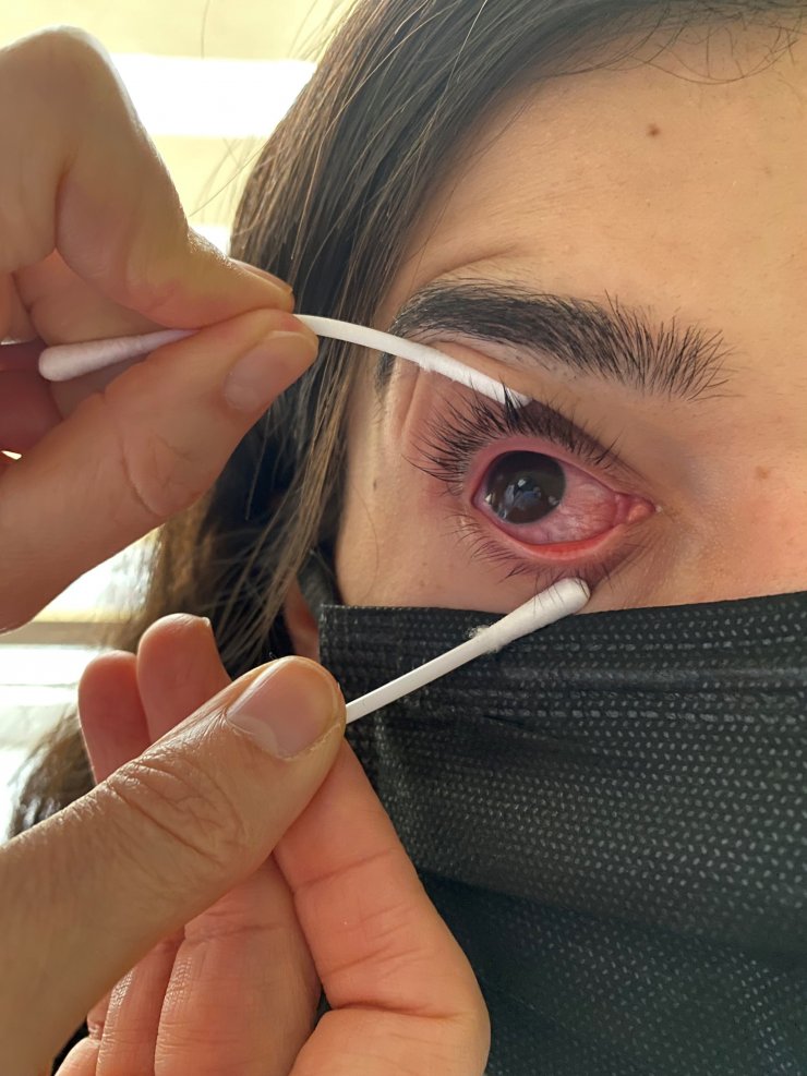 Şimdi de gözlerde virüs salgını; uzmanlar adenovirüse karşı uyarıyor