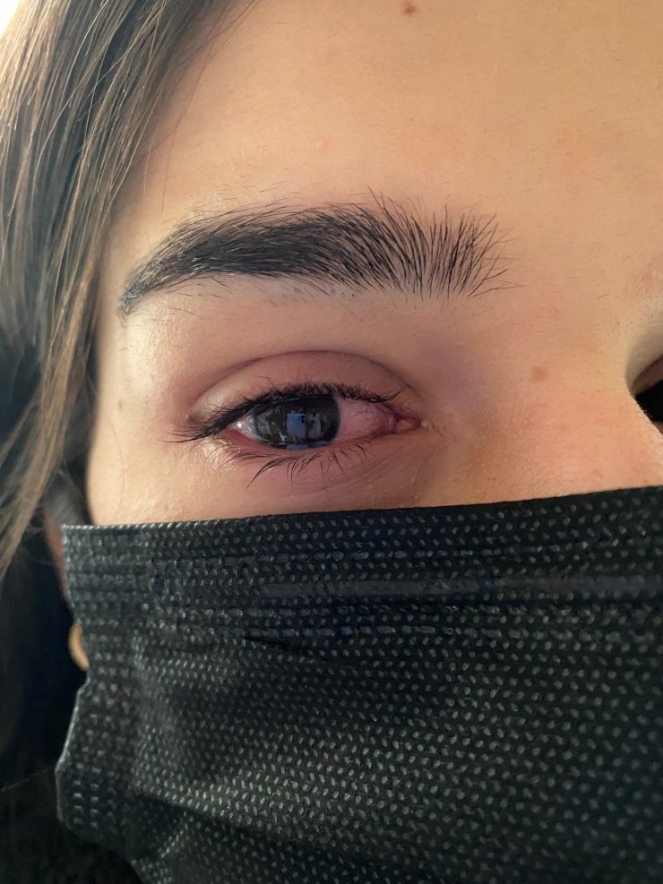 Şimdi de gözlerde virüs salgını; uzmanlar adenovirüse karşı uyarıyor