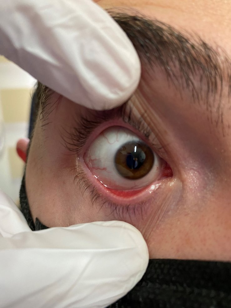 Şimdi de gözlerde virüs salgını; uzmanlar adenovirüse karşı uyarıyor