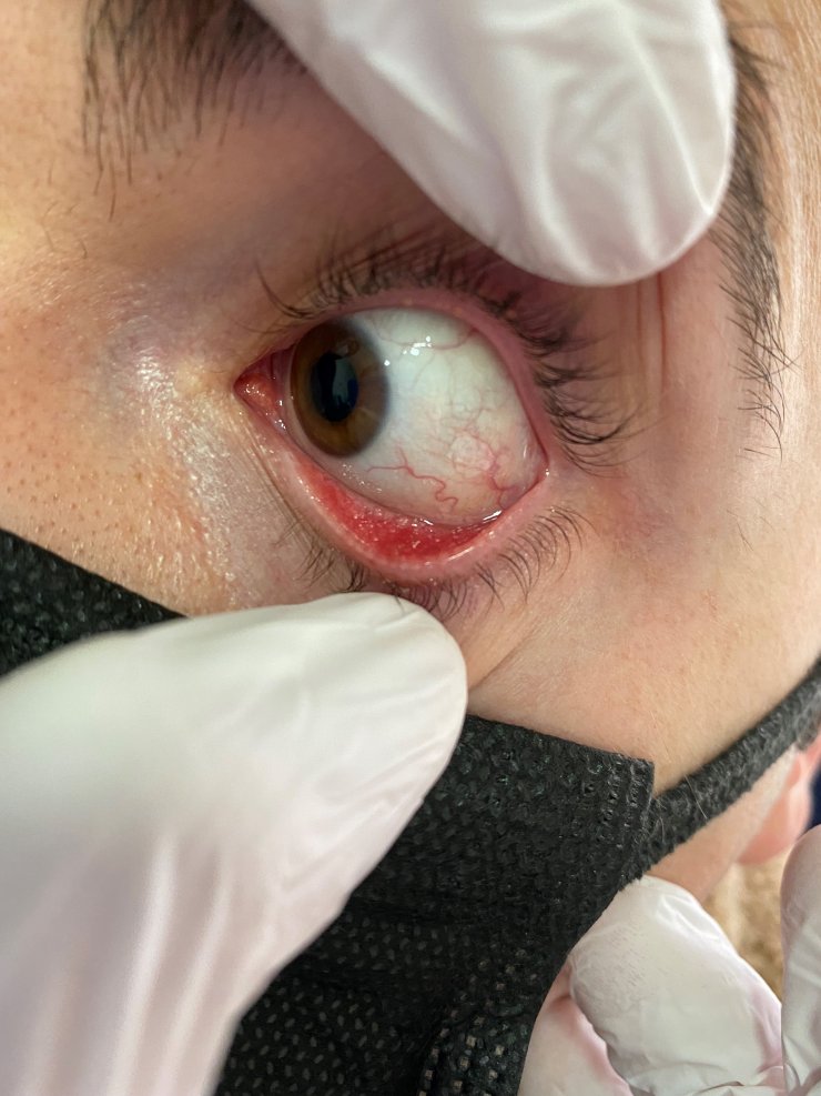 Şimdi de gözlerde virüs salgını; uzmanlar adenovirüse karşı uyarıyor