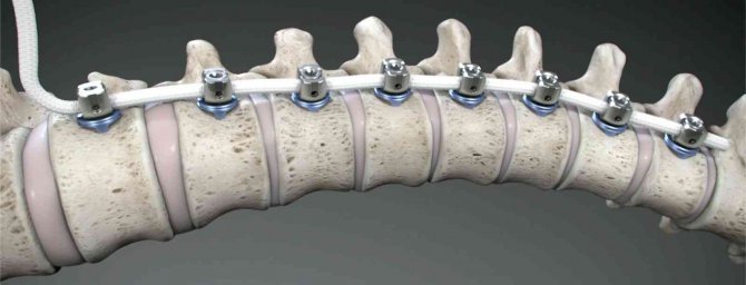 Skolyoz tedavisinde artık eğriliğin düzeltilmesi mümkün!