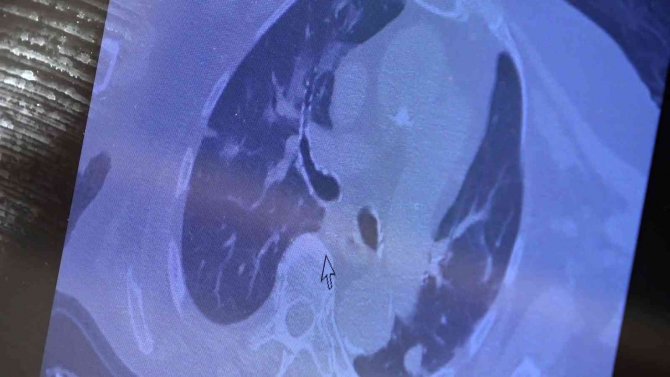 Kovid-19’da yeni hasta profili: "Aşı oldum hastalandım"