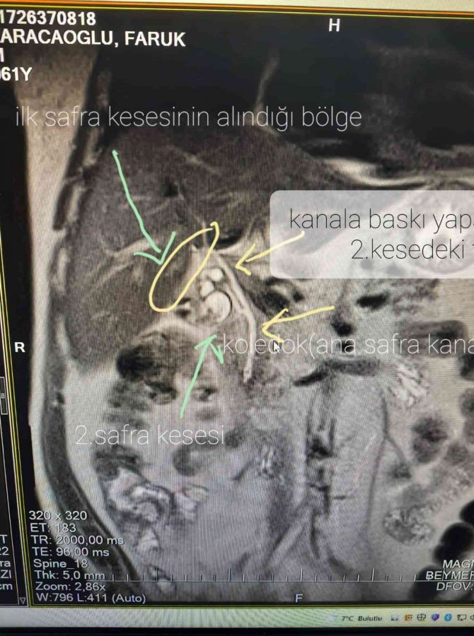 13 yıl sonra ikinci bir safra kesesi olduğunu öğrenince şok oldu