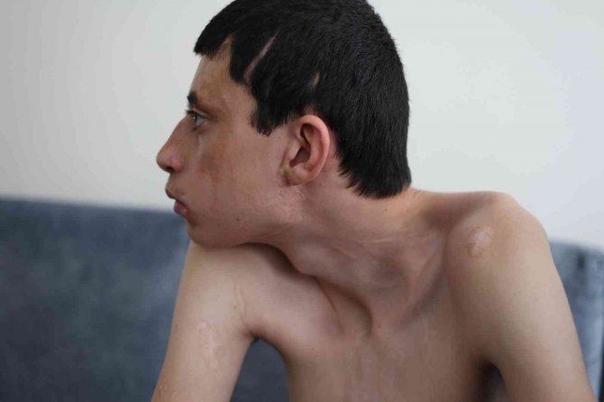 Kezzap atılan engelli çocuk ile ailesinin yaşam mücadelesi