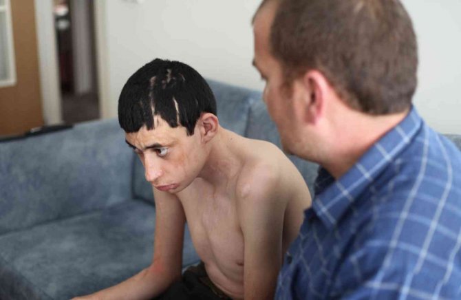 Kezzap atılan engelli çocuk ile ailesinin yaşam mücadelesi