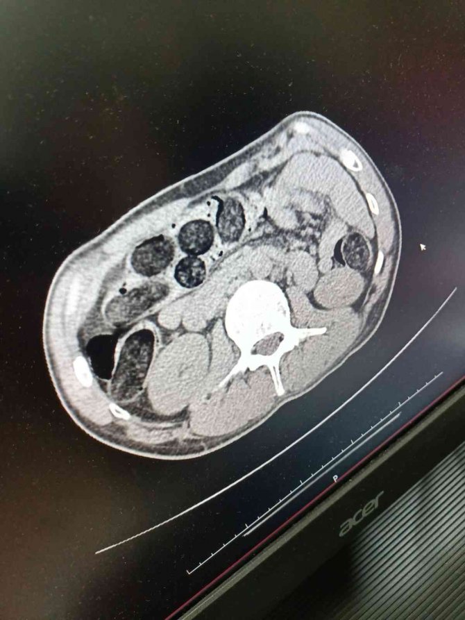 Midesine sakladığı 542 gram eroinle yakalandı