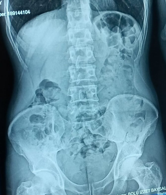 Midesine sakladığı 542 gram eroinle yakalandı