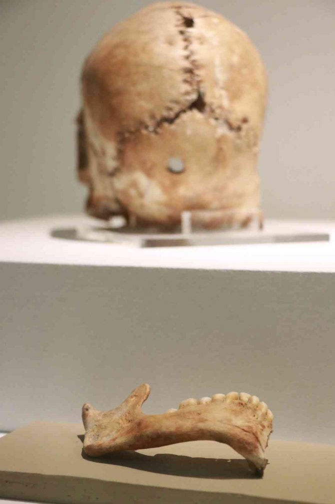 Dünyanın ilk beyin ameliyatı binlerce yıl önce Aksaray’da yapıldı