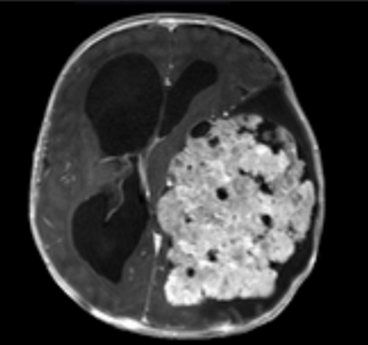 3 aylık bebeğin beynini saran tümör temizlendi