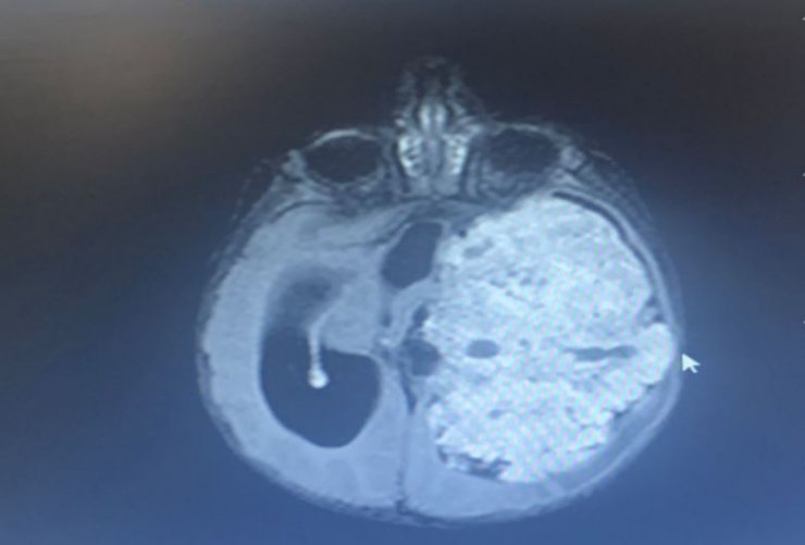 3 aylık bebeğin beynini saran tümör temizlendi