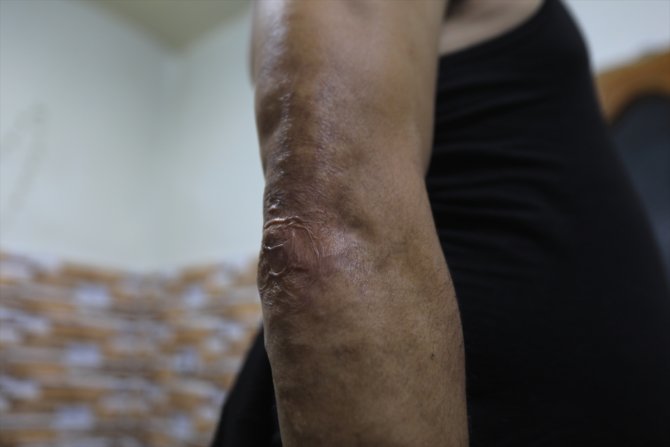 Terör örgütlerinin döşediği mayınlar binlerce ailenin hayatını kararttı