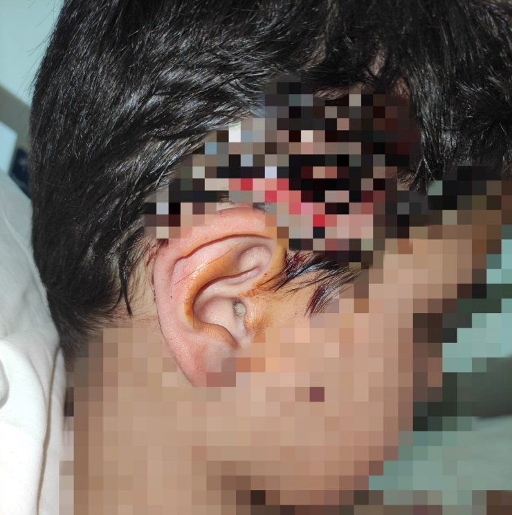 Okul yolunda 8 köpeğin saldırdığı çocuğun vücuduna 80 dikiş atıldı