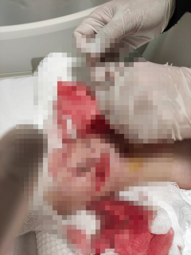 Okul yolunda 8 köpeğin saldırdığı çocuğun vücuduna 80 dikiş atıldı