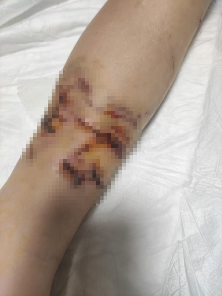 Okul yolunda 8 köpeğin saldırdığı çocuğun vücuduna 80 dikiş atıldı