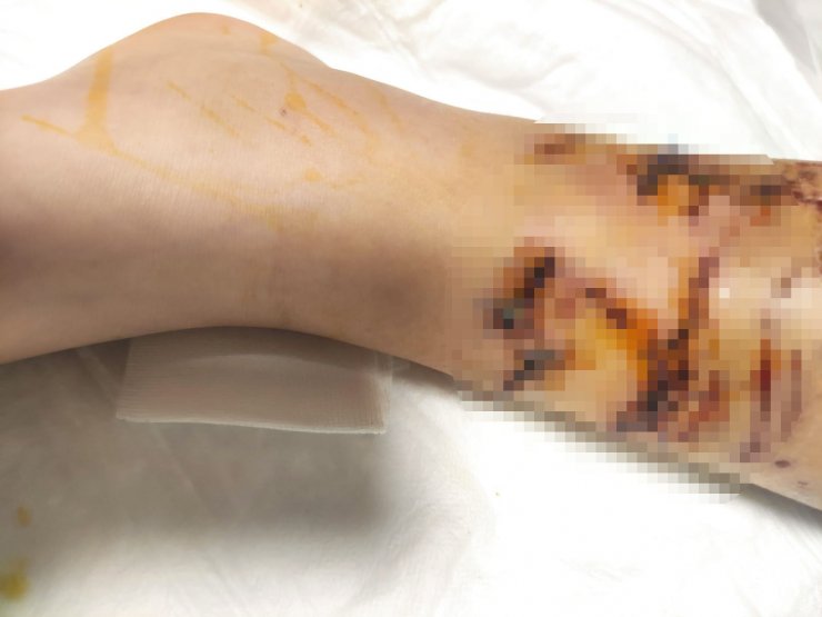 Okul yolunda 8 köpeğin saldırdığı çocuğun vücuduna 80 dikiş atıldı