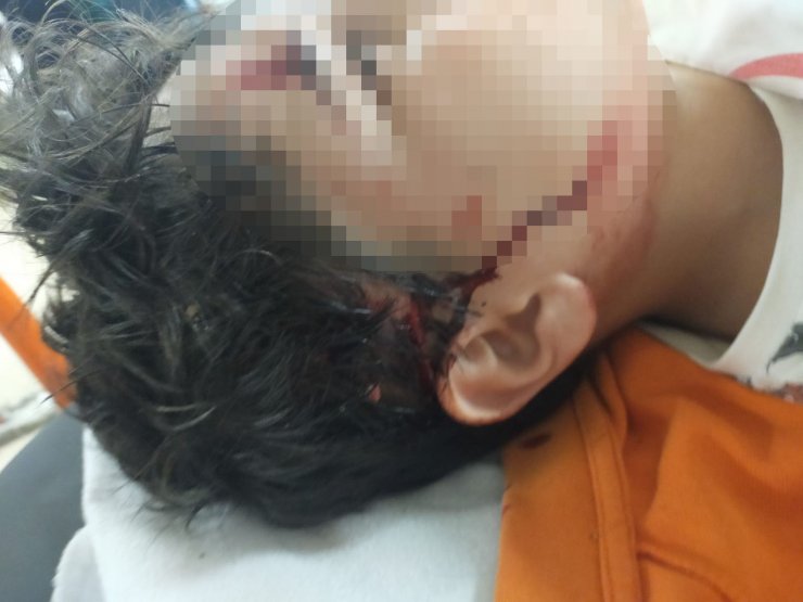 Okul yolunda 8 köpeğin saldırdığı çocuğun vücuduna 80 dikiş atıldı