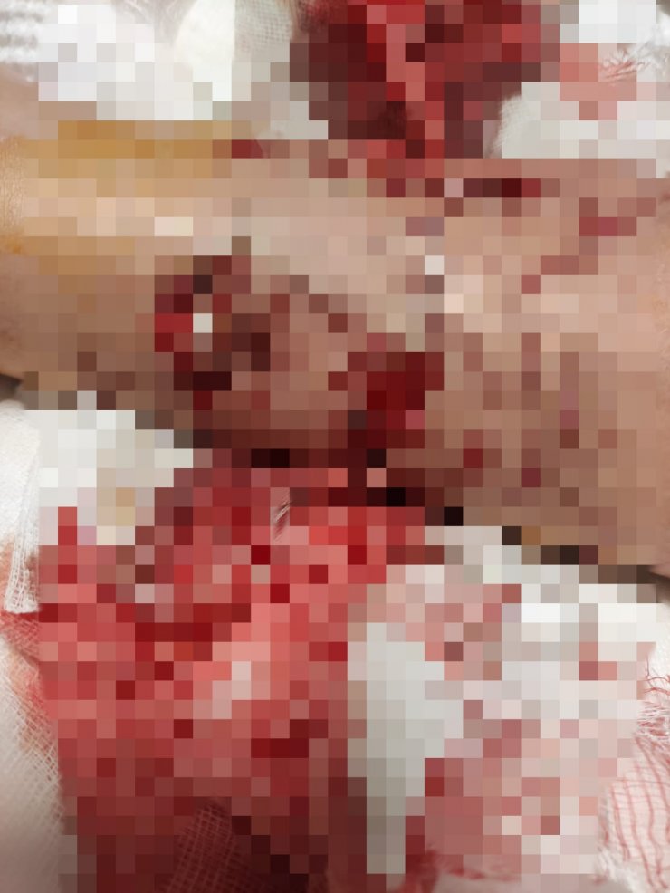 Okul yolunda 8 köpeğin saldırdığı çocuğun vücuduna 80 dikiş atıldı