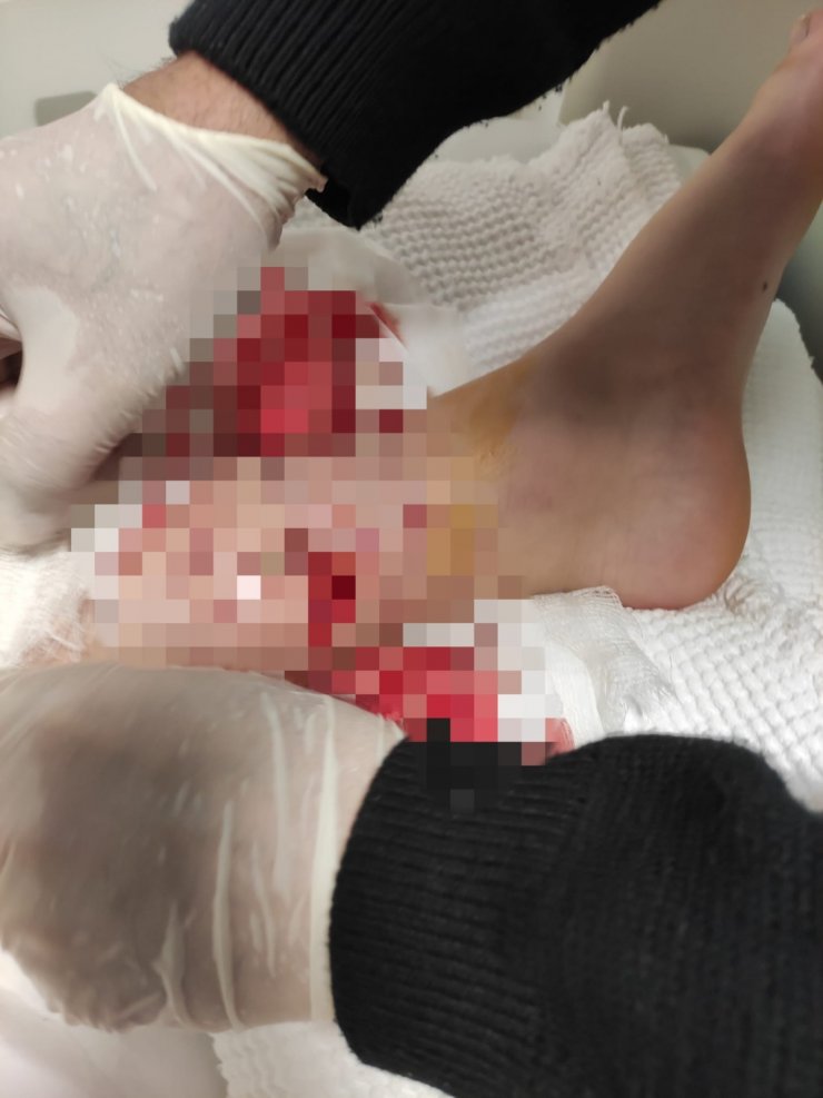 Okul yolunda 8 köpeğin saldırdığı çocuğun vücuduna 80 dikiş atıldı