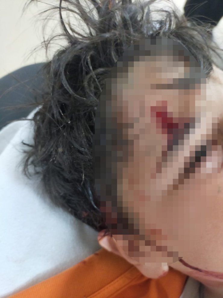 Okul yolunda 8 köpeğin saldırdığı çocuğun vücuduna 80 dikiş atıldı