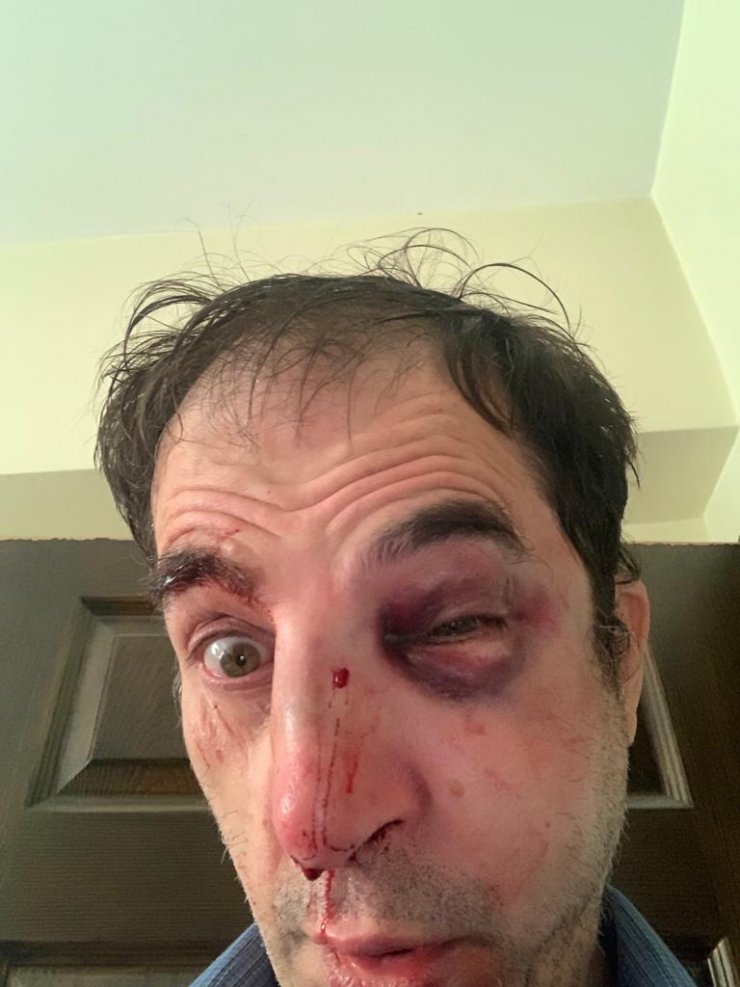 Profesöre 'burun ameliyatı' dayağına 28'er yıla kadar hapis talebi